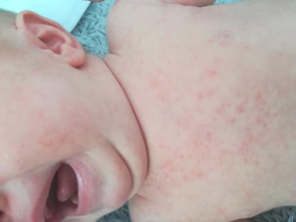 Kožní vyrážka. Může to být akné nebo potničky?