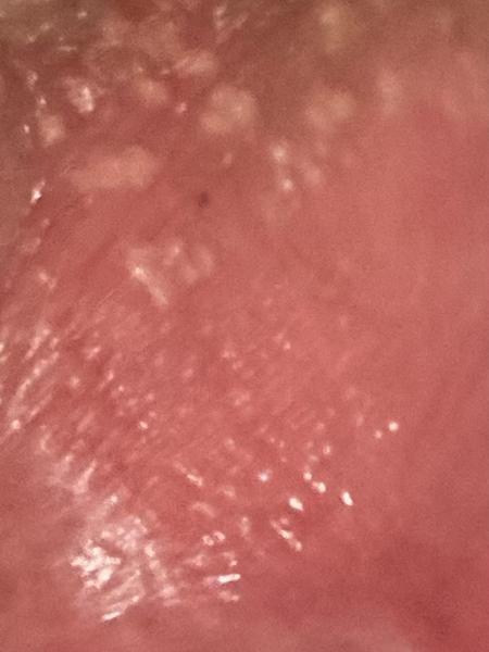 Bradavičky na genitáliích. Co by to mohlo být?