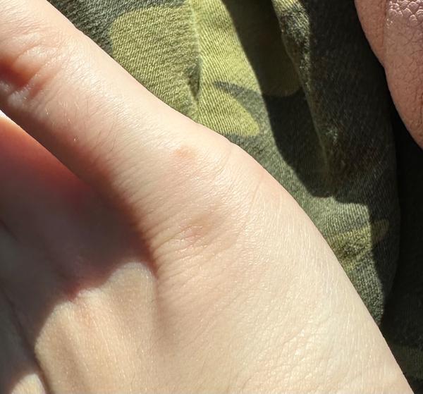 Svědivé puchýřky na těle. Je to svrab nebo alergie?