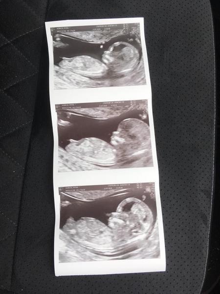 Foto z ultrazvuku. Holčička nebo klučík?