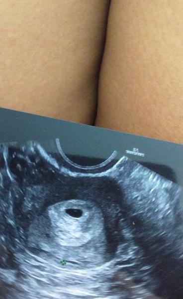 Kolik týdnů může trvat těhotenství?