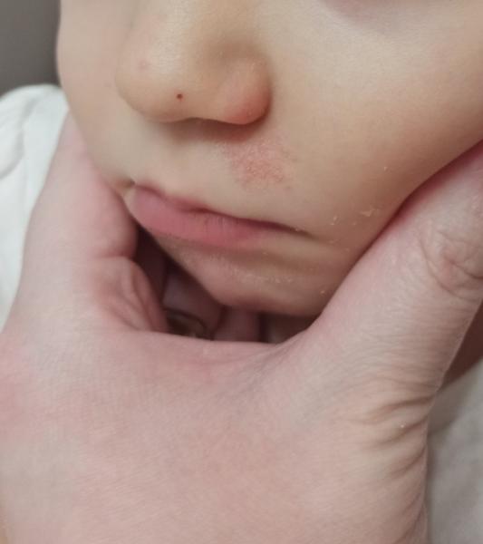 Ekzém, kvasinka nebo ABKM?