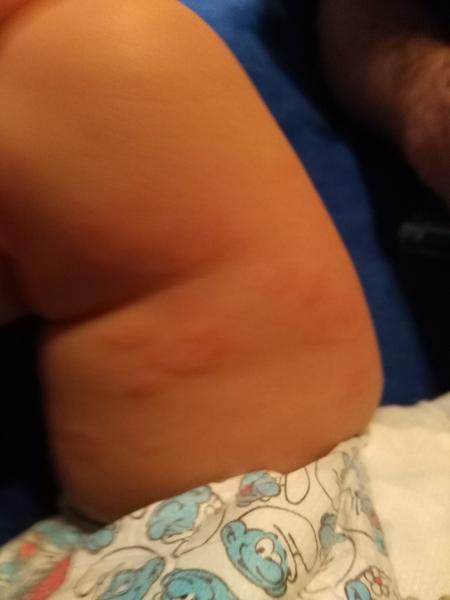 Kožní alergická reakce, z čeho by to mohlo být?