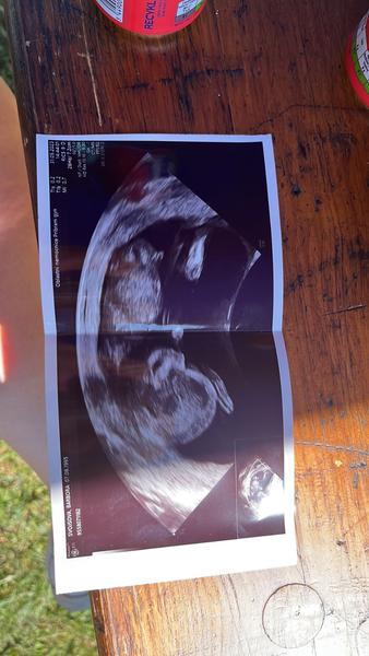 Růst pohlaví v 13. týdnu: Jak to vypadá na ultrazvuku?