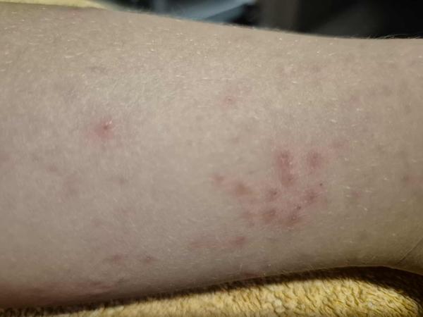 Neznámá vyrážka na nohou tříletého dítěte. Co by to mohlo být?