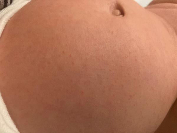 Vyrážka. Co by to mohlo být?