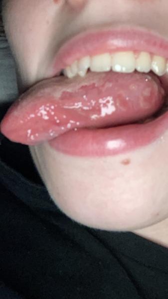 Fleky na jazyku. Jaký je na to Váš názor? Co by to mohlo být a co by mohlo pomoci?