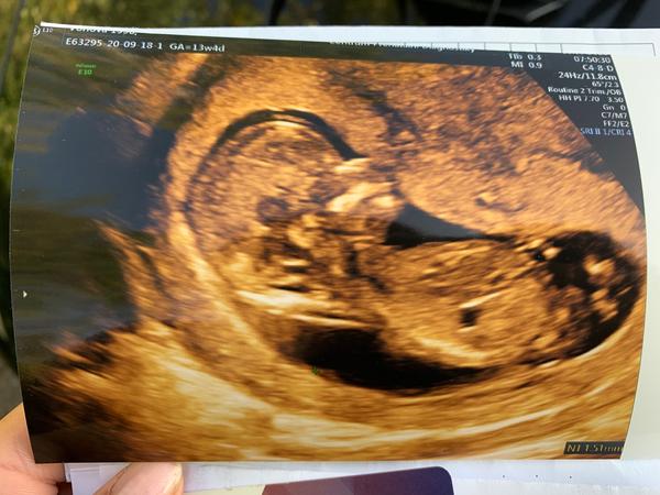 Pohlavní hrbolek. Je vidět?