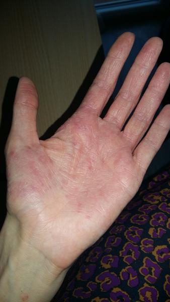 Ekzém po porodu. Může být způsoben kvasinkami?