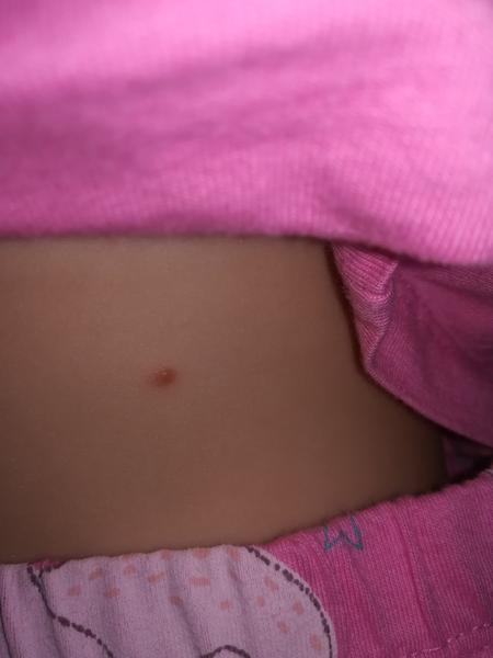 Reakce na klíště. Je to možné? Není potřeba udělat nějaký krevní obraz?