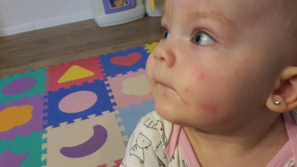 Kopřivka u ročního dítěte