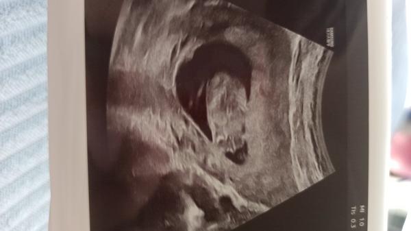 Pohlaví podle fotky z ultrazvuku...