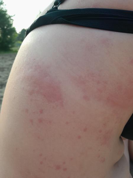 Svědivé pupínky po těle: Jaké jsou možné příčiny?