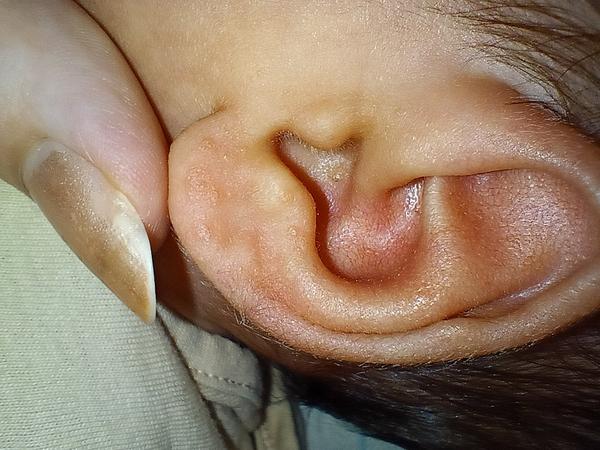 Stroupky na uších: Co způsobuje malé pupínky?