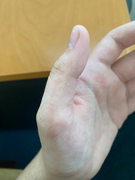 Je to svrab? Jak rozpoznat svrab a co s ním dělat?