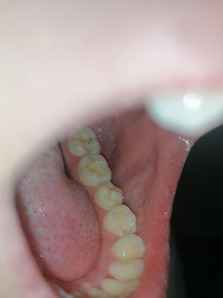 Kaz na zubu, i když jsem byla na kontrole. Je možné, že to pan doktor neviděl?