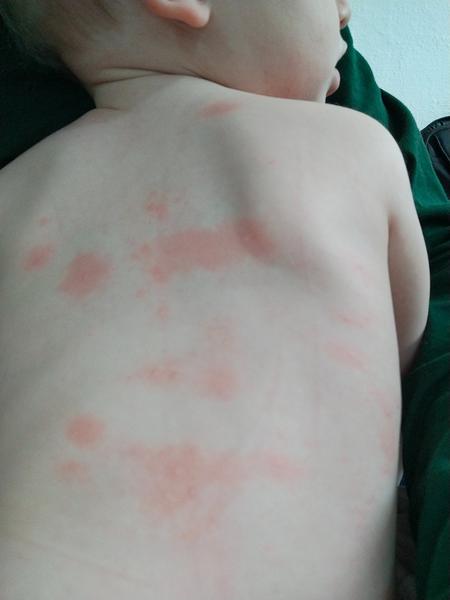 Má někdo představu, co je to za vyrážku?