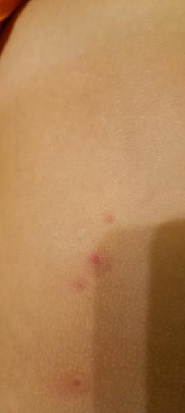 Pupínky na zádech. Co by to mohlo být?