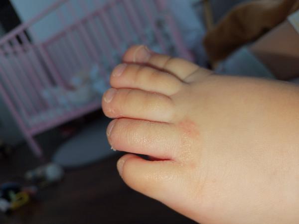 Vyrážky na noze dítěte. Co může být příčinou a jak léčit?