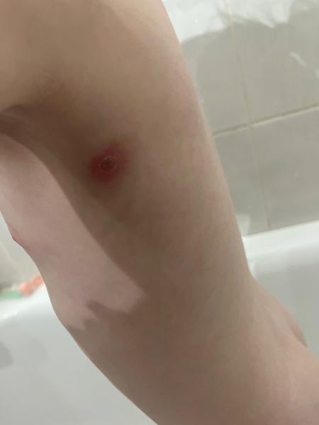 Léčba hnisavého pupínku u dítěte. Zkušenosti a rady?