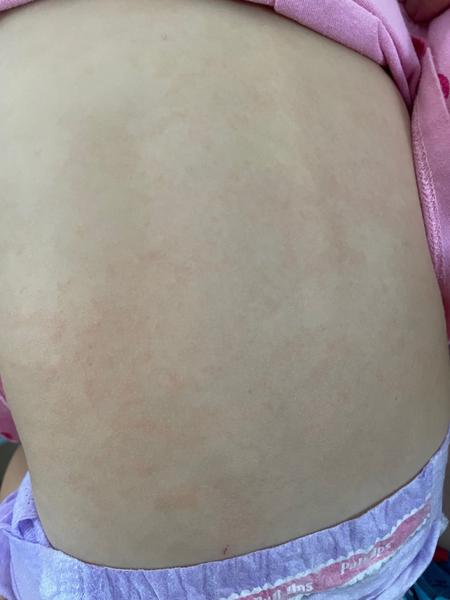 Kopřivka u malého dítěte: Může teplota naznačovat něco vážnějšího?