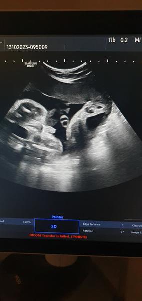 Pohlaví miminka: Jaké pohlaví je na ultrazvuku?