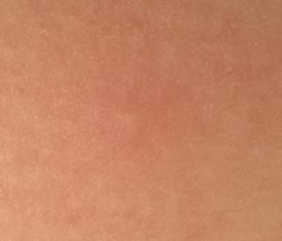 Záhadné pupínky. Co by to mohlo být?