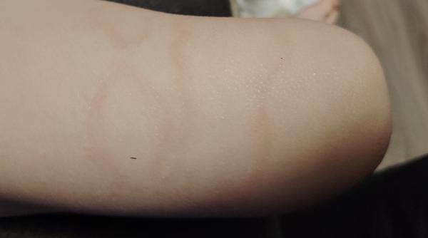 Vyrážka u syna. Za jak dlouho zmizí a kdy by mohl jít do kolektivu?