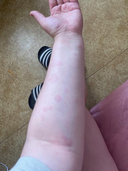 Alergie nebo kopřivka?