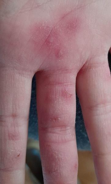 Jak identifikovat ekzém? Poradíme, co hledat.