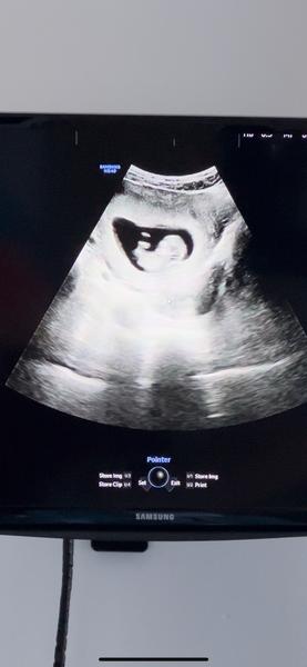 Pohlaví dítěte. Lze určit?