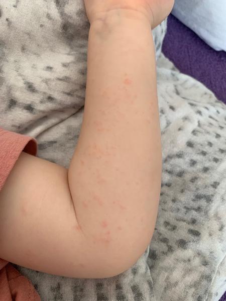 Jak rozpoznat ekzém u dítěte? Rychlé rozlézání vyrážky.