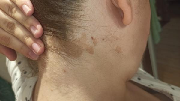 Skvrny za ušima a ve vlasech. O co by se mohlo jednat?