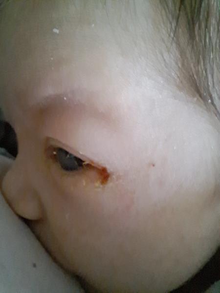 Co pomáhá na hnisavé oko u miminka?