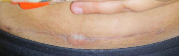 Boule na jizvě po císaři. Je nutná další operace?