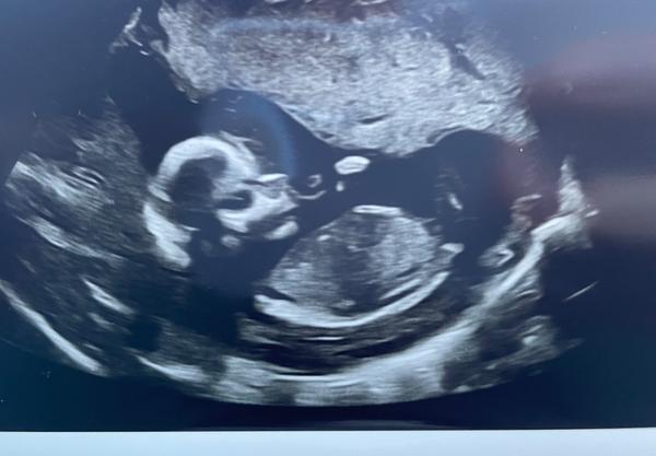 Můžete odhadnout pohlaví dítěte na základě intuice?