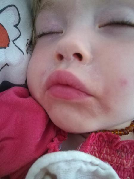 Atopický ekzém? Kvasinky? Co by to mohlo být?