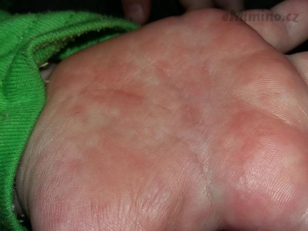 Ekzém? Alergie? Co by to mohlo být?