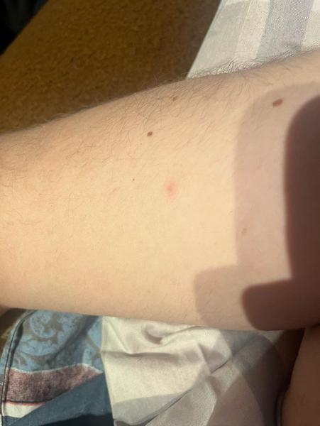 Svědění a pupínky po těle. Může to být svrab?