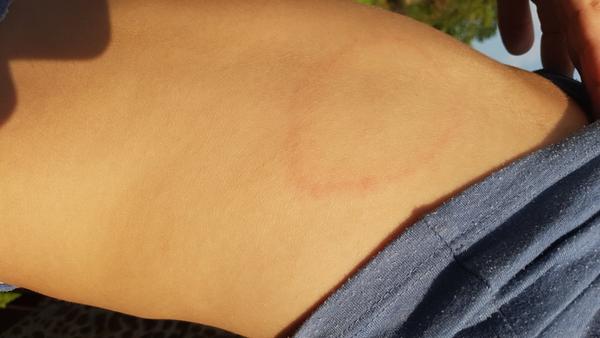 Fleky. Co to může být?