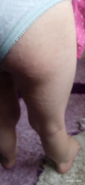 Vyrážka. Co by to mohlo být?