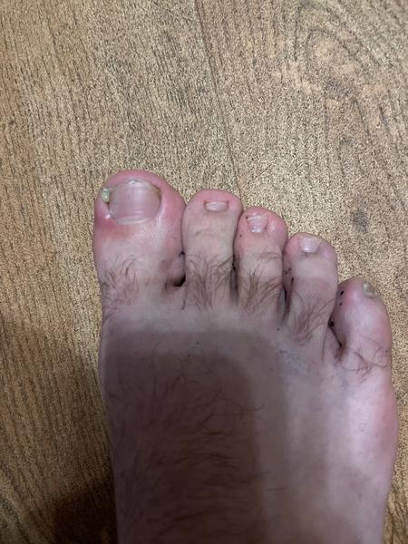 Jak řešit zarostlý nehet? Rady a zkušenosti ze Slovenska