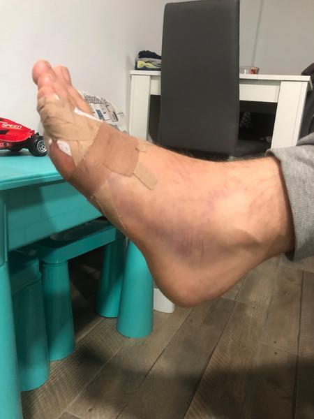 Zlomený malíček na noze: Jak řešit otok a bolest?