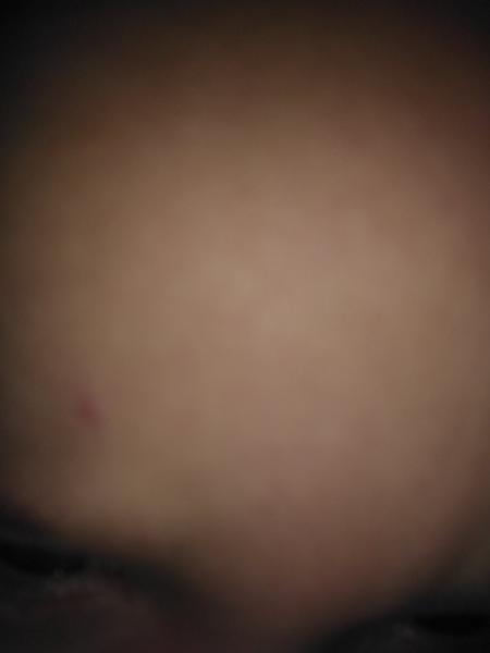 Ekzém nebo neštovice?