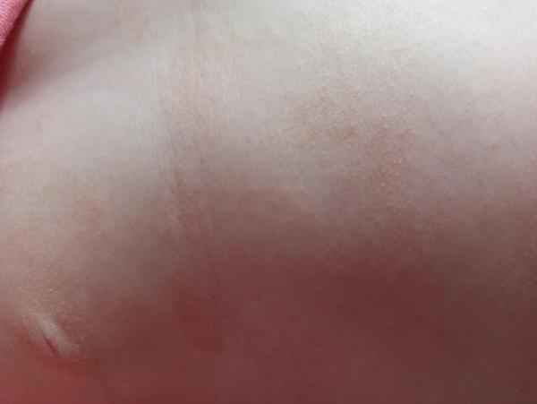 Krupička na bříšku u miminka. Jaké jsou příčiny a řešení?