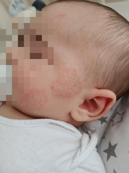 Jak léčit dětský ekzém v obličeji? Rady a tipy