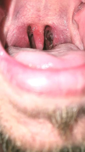 Je špatné polykání a bolák na mandli důvod k pohotovosti?