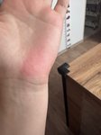 Může být zarudnutí dlaní znamením problému s játry?