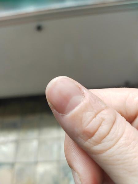 Je tmavší čára na nehtu důvodem k obavám?