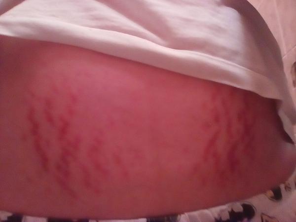 Rozjeté strie v 23tt, co na ně používáte?